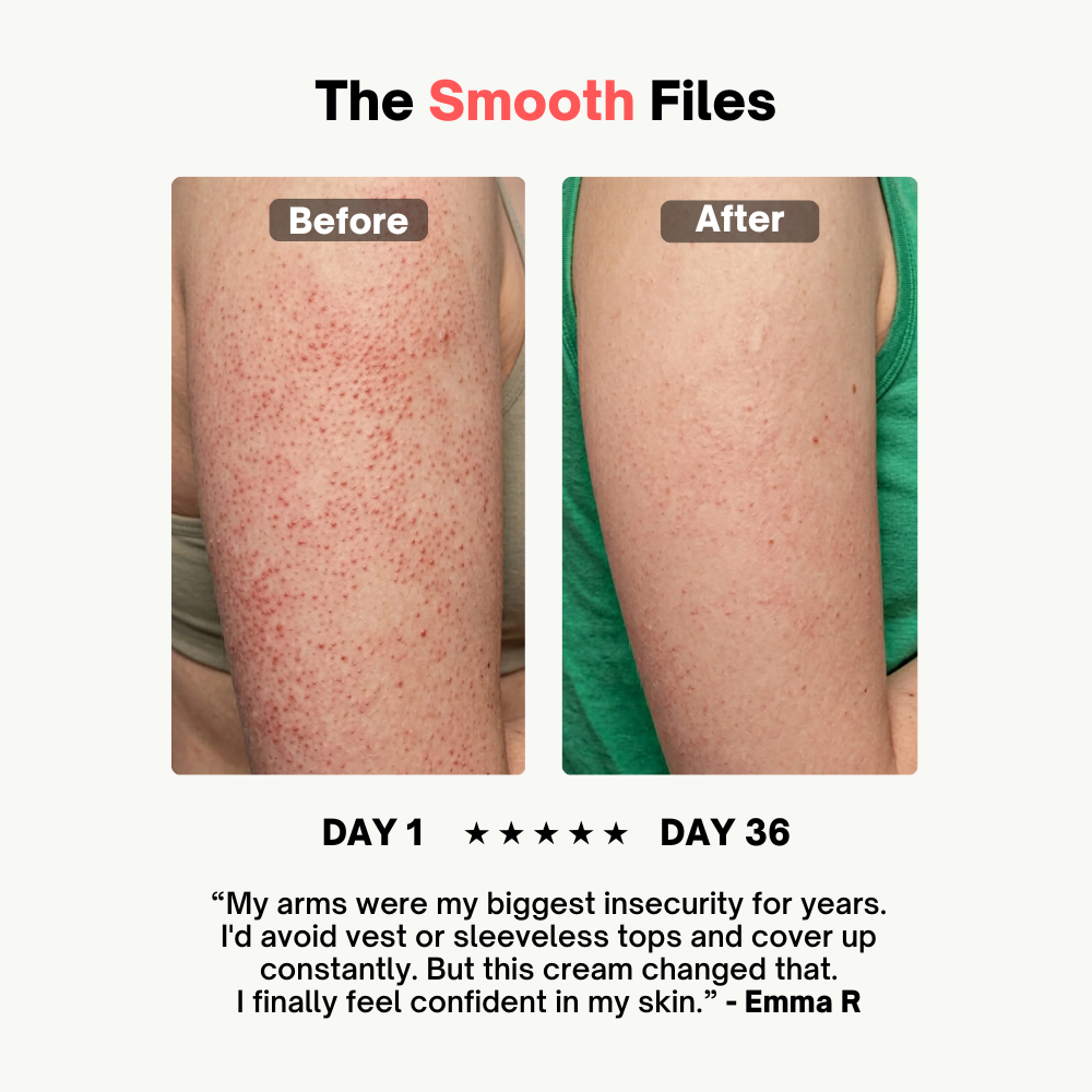 Smooth Away Keratosis Pilaris Cream