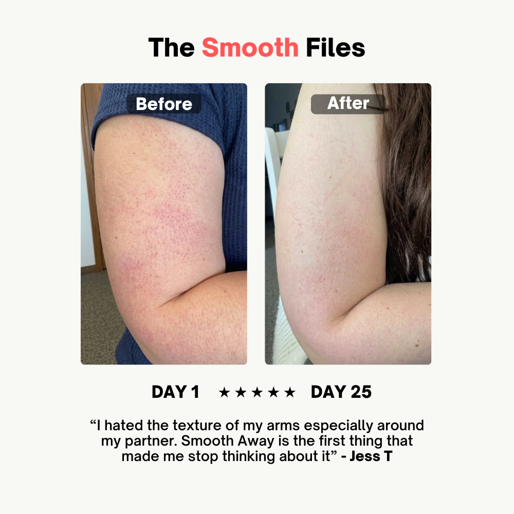 Smooth Away Keratosis Pilaris Cream